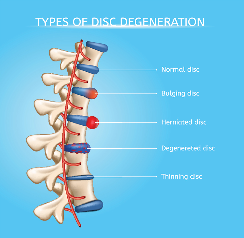 disc-degeneration_spineworks