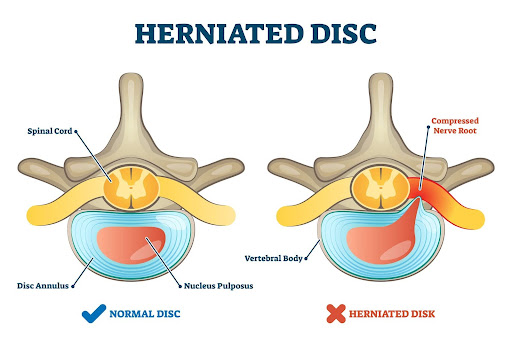 diskokili diagramma spineworks