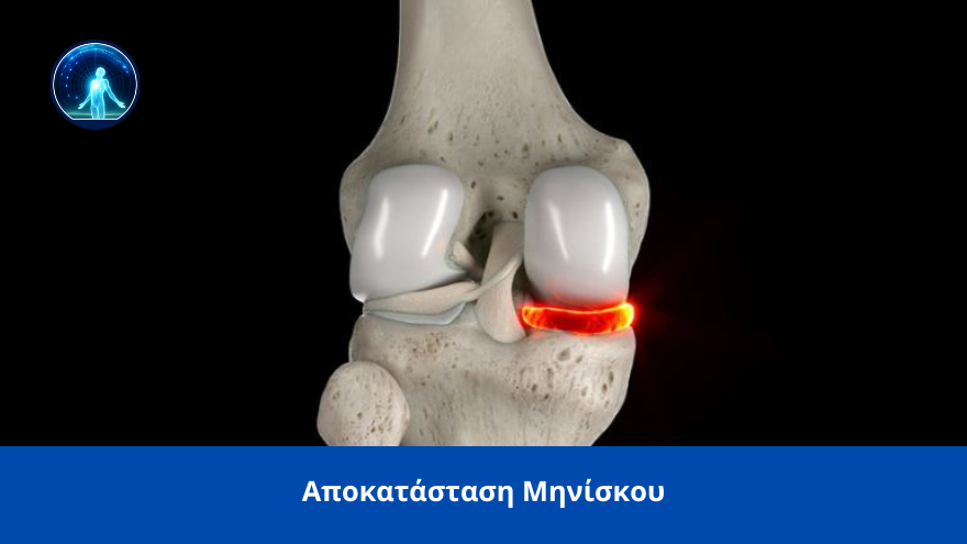 αποκατάσταση ρήξης μηνίσκου spineworks
